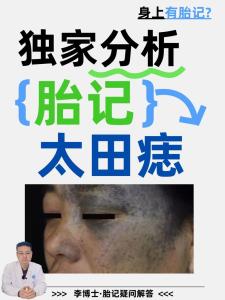 臉上有胎記好嗎？體相中面部胎記詳細(xì)分析