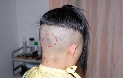 后腦勺下有痣藏頭發(fā)里
