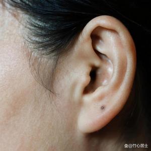 耳垂上長痣