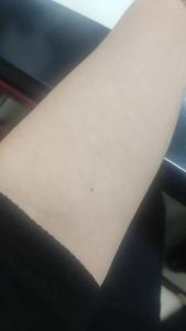 手臂內側有痣