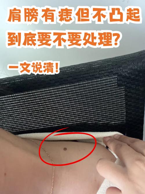 痣凸起好還是不凸起好