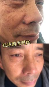 男人鼻翼有痣好不好？存不住錢(qián)，沒(méi)有積蓄！
