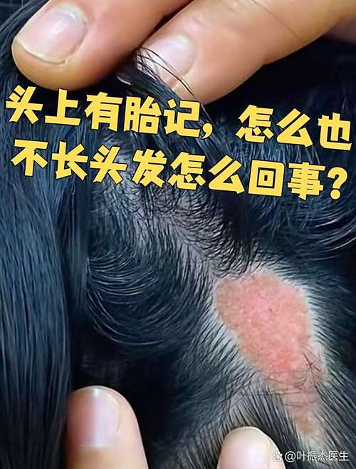 胎記長在后腦勺的人命運(yùn)如何？財(cái)運(yùn)非常旺盛！