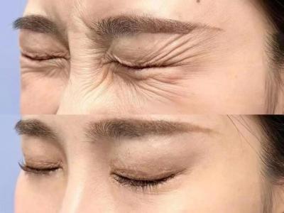 魚尾紋和笑紋圖片對比