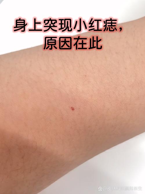肚子左側肋骨位置有朱砂痣 吉痣多財運
