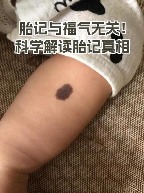 從胎記看運勢怎么樣