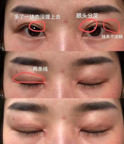 割雙眼皮影響運氣嗎