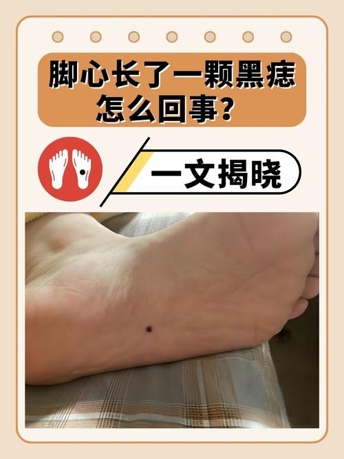腳底有痣代表什么 男人的右腳底腳心有痣有一顆痣好不好