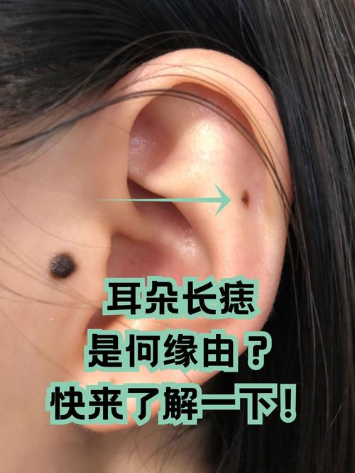 右耳朵有痣的女人 右耳朵邊長痣的女人代表什么