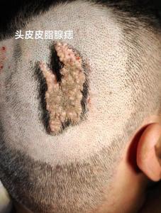 男孩頭頂上有痣 頭上長肉痣的男人代表什么好不好