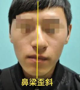 歪面相 鼻子歪了是什么預(yù)兆