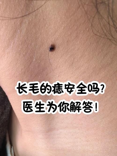 痣上面為什么長(zhǎng)毛 痣上長(zhǎng)毛代表有福氣嗎