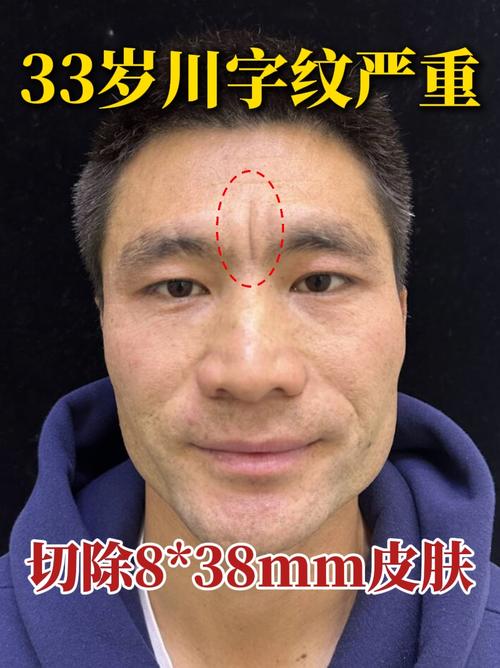 額頭有井字紋好不好