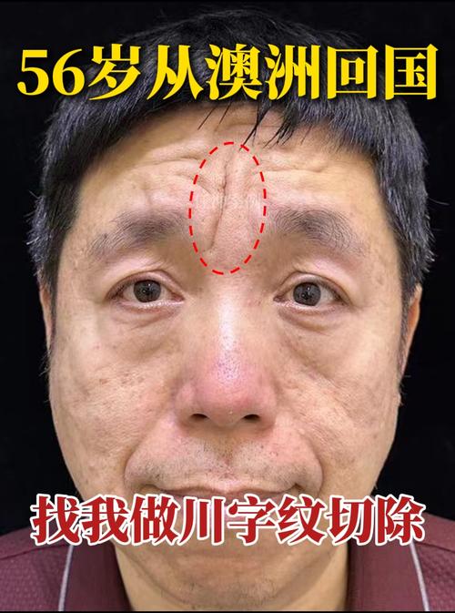 額頭皺紋看相：從額頭皺紋看性格與命運