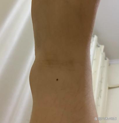 注定成功女人痣 腳踝痣事業有成