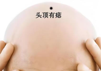 頭上的痣長在哪個位置好
