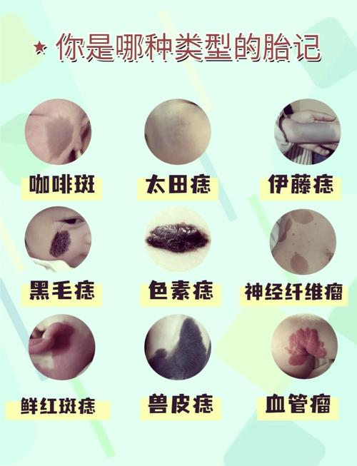 胎記長在什么地方好，體相中胎記詳細(xì)分析