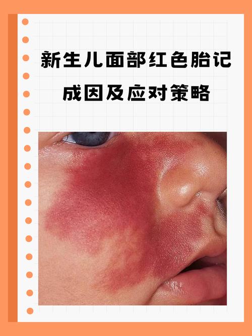 紅色胎記是什么命