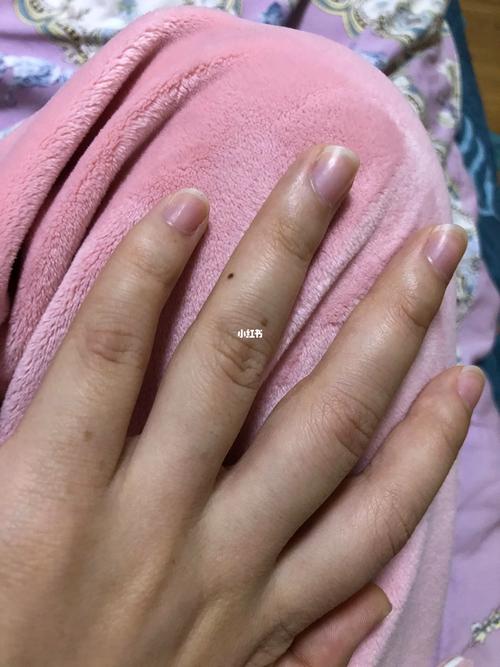 女左手無名指?jìng)?cè)面有痣