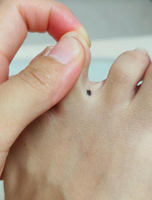 女人腳趾縫長痣