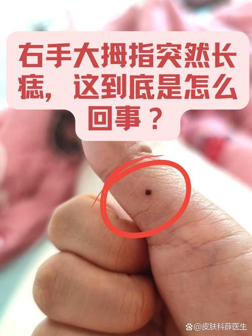 右手大拇指有痣